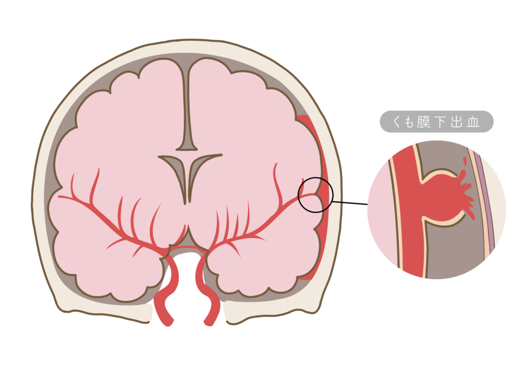 くも膜下出血の病態を説明するイラスト