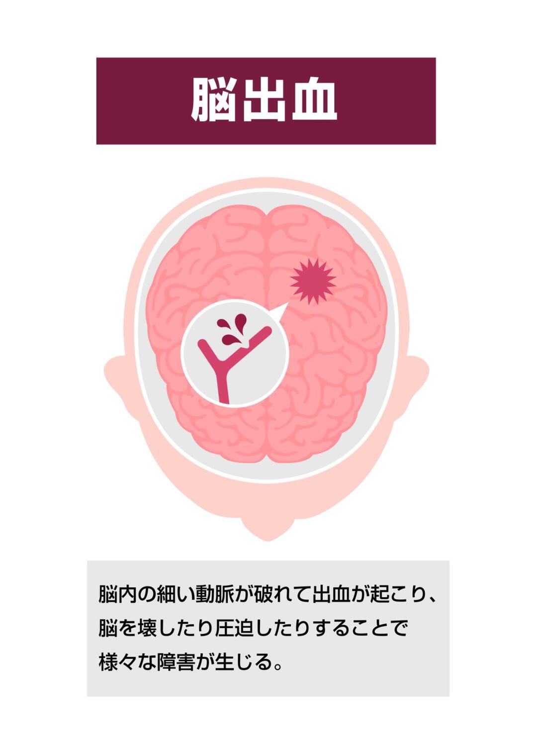 「脳出血」という見出しと脳のイラスト。「脳内の細い動脈が破れて出血が起こり、脳を壊したり圧迫したりすることで様々な障害が生じる。」という解説文が含まれている。