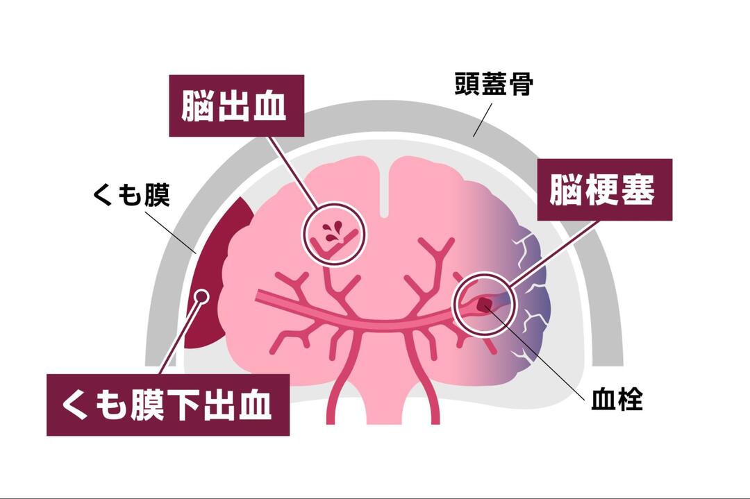 「脳出血」「脳梗塞」「くも膜下出血」の病名と、それぞれの発生部位や血栓などの位置を示した脳の断面イラスト