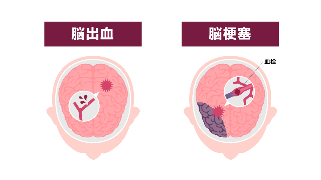 「脳出血」と「脳梗塞」の2つの症状について、脳内の血管の破裂や血栓による詰まりの様子を比較解説したイラスト